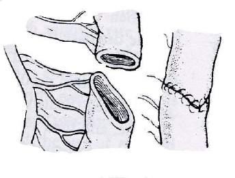 + Sau khi cắt bỏ đoạn ruột trên chỗ teo bị giãn to, thành dày, nếu kích thước 2 đầu ruột vẫn chênh lệch nhau thì mở rộng thêm đầu ruột dưới bằng cách cắt chéo 30 0-45