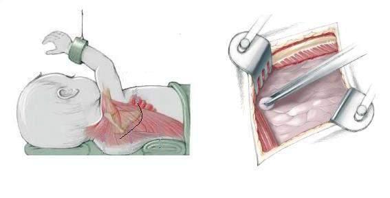 3. Thực hiện kỹ thuật - Ngư i bệnh nằm nghiêng bên trái, có độn dưới ngực tương ứng với khoang liên sư n IV-V. - Đư ng mổ theo đư ng mở ngực sau bên, qua gian sư n 4 bên phải.