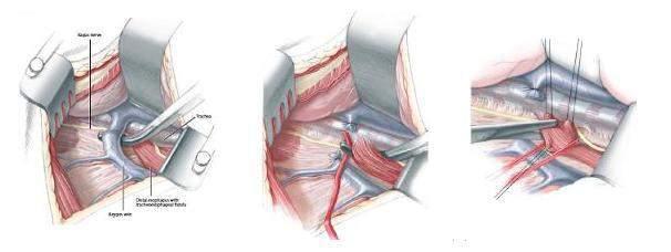 Đư ng mổ ngực ngoài màng phổi - Dùng van mềm kéo màng phổi và phổi ra phía trước. - Bộc lộ và cắt đ i tĩnh mạch đơn. Hình 3.