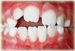 Tuy nhiên nếu thói quen này k o dài đến th i kỳ mọc răng vĩnh viễn (6-7 tuổi) thì sẽ gây ra các rối loạn đến việc mọc răng cũng như rối loạn sự phát triển xương hàm II.