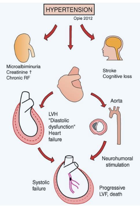 THA và các biến chứng TM - Brain - Kidney - Heart - Eye, Aorta TL: