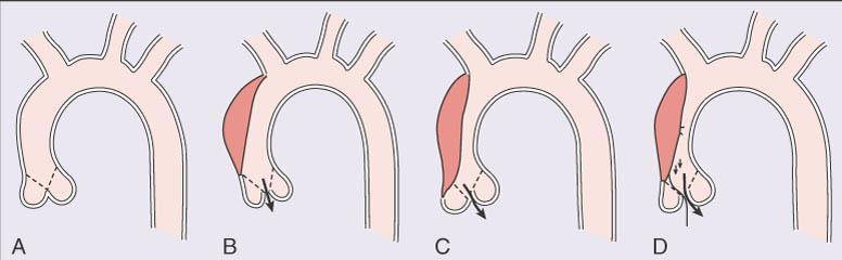 Cơ chế hở van ĐMC do bóc tách ĐMC đoạn gần TL: Isselbacher EM. Diseases of the Aorta.