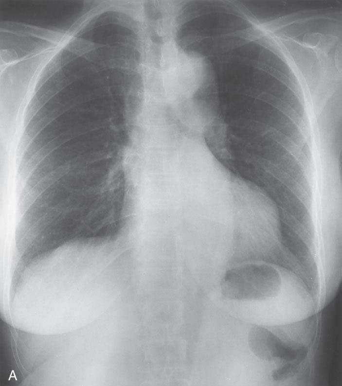 X-quang ngực một bệnh nhân bóc tách ĐMC