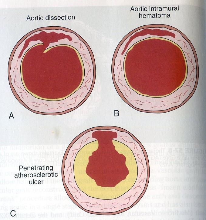 Hội chứng động mạch chủ cấp Bóc tách ĐMC cổ điển (classic AD): 90% Huyết khối trong vách ĐMC Loét xuyên thấu do xơ vữa động mạch (Penetrating
