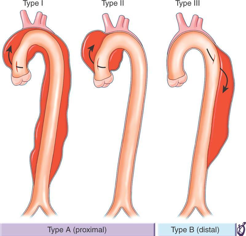 Phân loại bóc tách ĐMC TL: Isselbacher EM. Diseases of the Aorta.