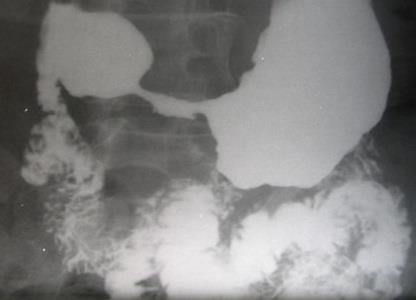 12 ống soi mềm trong nội soi dạ dày, vai trò của chụp X quang dạ dày có thuốc cản quang được xếp xuống hàng thứ yếu.