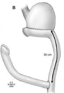 5: Nối dạ dày với hỗng tràng kiểu Billroth II hoặc Roux-en-Y [64] - Bệnh phẩm gồm phần dạ dày đã cắt và các hạch vét được gửi đi làm giải phẫu bệnh lý.