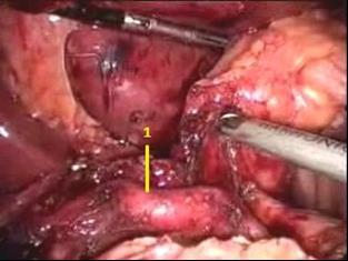 47 Bước 6: Phẫu tích vùng cuống gan và giải phóng mạc nối nhỏ dạ dày Phẫu tích bộc lộ cuống gan kẹp và cắt động mạch môn vị, vét hạch nhóm 5 và