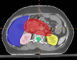 51 - Bệnh nhân được chụp CT scan để mô phỏng trước xạ trị với chất cản quang đường tĩnh mạch, độ dày lát