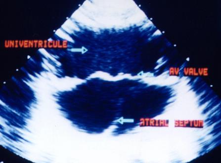Siêu âm tim Mặt cắt 4 buồng từ mỏm: tâm thất độc nhất và thông liên nhĩ tiên phát lớn gần như tâm