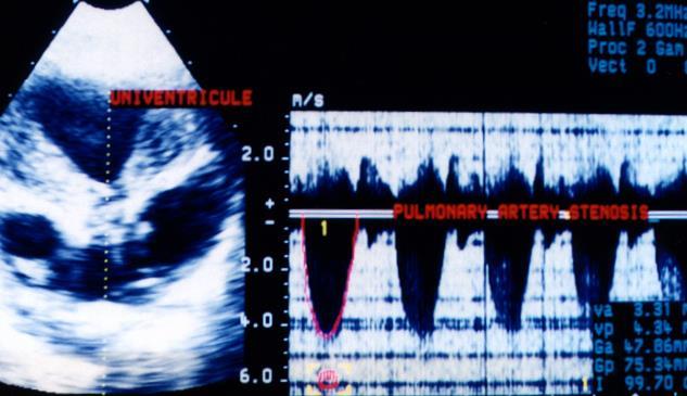Siêu âm tim Mặt cắt dưới sườn: Doppler liên tục dòng máu ngang van ĐMP- hẹp ĐMP nặng với độ chênh