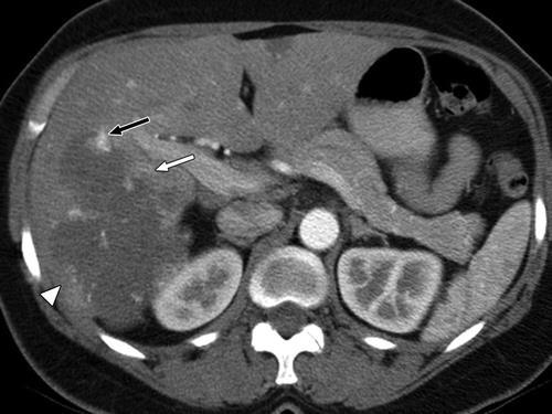 Fig. 1A 55-year-old woman with hemangioma in right lobe of liver.