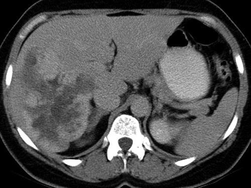 Fig. 1C 55-year-old woman with hemangioma in right lobe of liver.