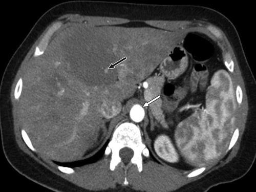 Fig. 2A 47-year-old woman with hemangioma in left lobe of liver.