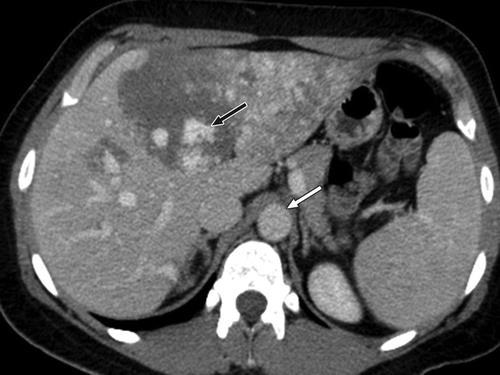 Fig. 2B 47-year-old woman with hemangioma in left lobe of liver.