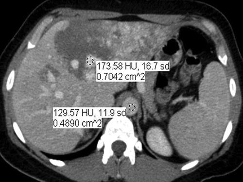 Fig. 2C 47-year-old woman with hemangioma in left lobe of liver. Difference at portal phase is quantitatively displayed by placing regions of interest on hemangioma and aorta revealing 44.