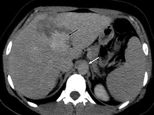 Fig. 2D 47-year-old woman with hemangioma in left lobe of liver.