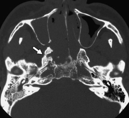 10 c d c. CT Scanner: UTVMH T3. Khối u lấp kín hầu-mũi, phá huỷ xương bướm. d. Hình ảnh MRI: Di căn hạch sau hầu (N1).
