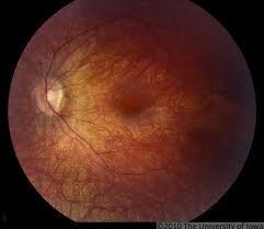 Hình 7. Tổn thương đáy mắt trong bệnh Leber 2.2.4.