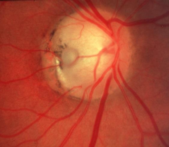 Lỗ khuyết đĩa thị Hình 5. Tồn lưu myelin 2.3.2. Lỗ khuyết đĩa thị (Optic Nerve Pits) Hình 6. Khuyết màng bồ đào, đĩa thị Dị tật của đĩa thị, thường gặp ở một mắt nhưng tỉ lệ hai mắt là 15%.