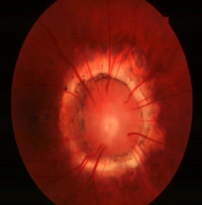 Trên lâm sàng nhìn thấy tổn thương màu trắng nằm theo hướng đi của các sợi thần kinh thường quanh đĩa thị, từ đĩa thị, hay có thể có một số vùng nằm xa đĩa thị (Hình 5).