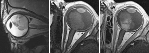 Hình 5: Hình ảnh can xi hóa ở mắt bị u nguyên bào võng mạc trên phim CT Scan (mũi tên) Chụp cộng hưởng từ (MRI) Do cần hạn chế tối đa tia xạ đối với trẻ có đột biến gen RB1, chụp cộng hưởng từ được