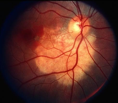 Nếu thị lực bị giảm do nguyên nhân màng tân mạch hắc mạc gây bong võng mạc xuất tiết vùng hoàng điểm, tổn thương mạch máu có thể được điều trị bằng laser quang đông tại chỗ hoặc liệu pháp quang động.