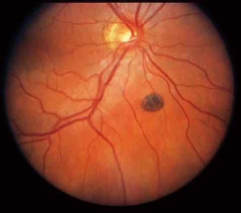 2.9.1. Triệu chứng Phì đại biểu mô sắc tố võng mạc bẩm sinh là một tổn thương có giới hạn rõ, phẳng, có sắc tố xuất hiện ở bất cứ vị trí nào trên đáy mắt.