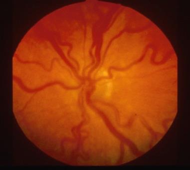 Ngoài ra, có thể có thêm một số dấu hiệu khác như giãn mạch máu trên bề mặt mống mắt, bờ đồng tử có màu đỏ, đồng tử giãn kém (Hình 9a và 9b) và vẩn đục dịch kính.