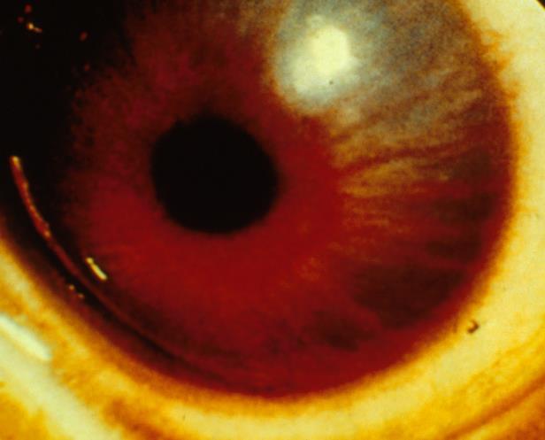 - BVMTĐN hình thái hung hãn cực sau (agressive posterior retinopathy of prematurity AP ROP) là bệnh xảy ra ở vùng I hoặc nửa sau vùng II, bệnh ở giai đoạn 3, kèm theo hiện tượng giãn và ngoằn ngoèo