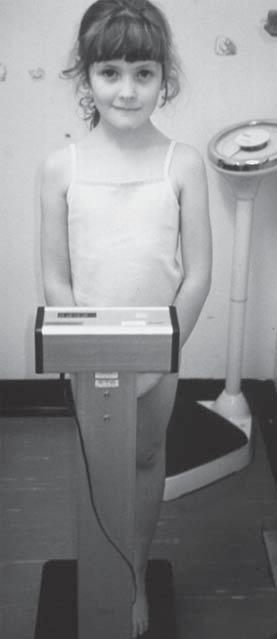 Hình. 2. Một trẻ nhũ nhi được đo trên bàn đo, cần 2 người để đánh giá chính xác chiều dài trẻ. Hình. 1. Cân trẻ lớn khi mặc quần áo mỏng nhẹ sử dụng cân được bảo hành và hiệu chỉnh thường xuyên.