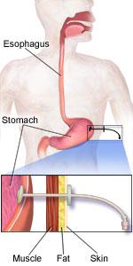 A percutaneous endoscopic gastrostomy (PEG) tube is a soft plastic tube that goes into your stomach from your abdomen. The tube has a port (opening) on the end that you put liquid food into.