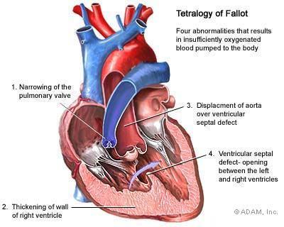 Cận lâm sàng: + XQ: bóng tim to (dầy thất và nhĩ phải), cung ĐM phổi dãn, tăng tuần phổi.