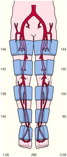 Chỉ số cổ chân-cánh tay (ABI: ankle brachial index) là một biện pháp thường được dùng để đánh giá bệnh nhân đau cách hồi: Chỉ số cổ chân - cánh tay (ABI) = HATT cổ chân HATT cánh tay Chỉ số cổ