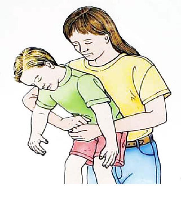 - Trẻ lớn (> 1 tuổi) Có thể dùng thủ thuật Heimlich hoặc vỗ lưng-ấn ngực như trẻ nhỏ.