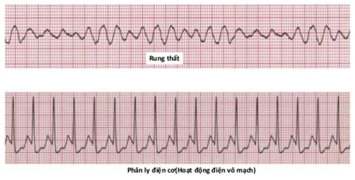 Khi đa nh giá kiểu nhi p tim vô tâm thu & hoạt đô ng điện vô mạch CPR 5 chu kz ~ 2 phút, đă t NKQ càng sớm càng tô t và đảm bảo thông khí có hiệu quả.