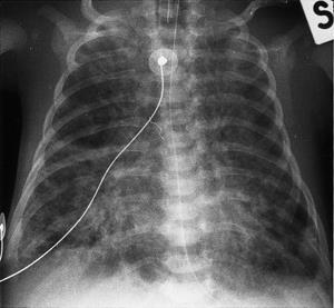 63. Kết quả XQ phổi: Bệnh màng trong có hình ảnh phế quản đồ. Khí máu động mạch của BN Lẹ lúc 7 giờ tuổi khi thở với FiO2 48%: ph 7,23; pco2 52 mmhg; po2 63 mmhg; HCO3-18; BE 8. Cần xử trí: 1.