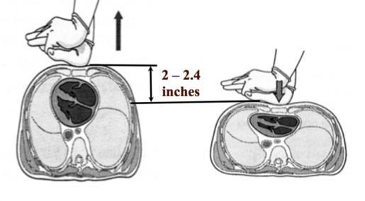 BIÊN ĐỘ NHẤN NGỰC Trong khi nhấn ngực bằng tay: cần nhấn ngực với đô sâu ít nhất 5cm tránh sâu hơn 6cm nhấn 5cm tốt hơn nhấn nông hơn nhấn > 6 cm dễ