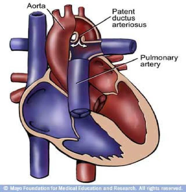 Chú thích : - Aort: ĐMC - Patent ductus arteriosus: COĐM - Pulmonary artery : ĐMP Hình 2: