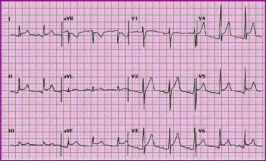 Đoạn ST chênh lên - Trong giai đoạn sớm của viêm màng ngoài tim cấp, đoạn ST thường chênh lên do quá trình khử cực của tâm thất bị ảnh hưởng (hình 1, 2, 3).