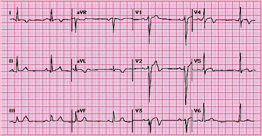 Hình 5 - Tiến triển của nhồi máu cơ tim trước vách - Hình ảnh điện tâm đồ cho thấy tiến triển của sóng Q trong nhồi máu cơ tim trước vách: mất sóng R từ V1-V3, đoạn ST chênh lên từ V2- V4, sóng T đảo