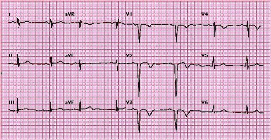 Hình 6 - Tiến triển muộn của nhồi máu cơ tim trước vách: giai đoạn muộn của nhồi máu cơ tim trước vách cấp. Hình ảnh QS từ V1-V3 và sóng T đảo ngược từ V2-V4.