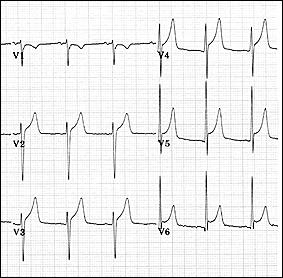 Một trong những điểm cần phân biệt là hình ảnh đoạn ST chênh lên ở cả các chuyển đạo đơn cực chi và các chuyển đạo trước tim trong phần lớn các trường hợp viêm màng ngoài tim cấp (47/48 bệnh nhân