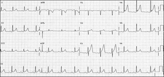 Hình 9 Hình ảnh tái cực sớm trên điện tâm đồ: ST chênh lên, rõ nhất ở các chuyển đạo giữa tim kèm theo sóng R cao và một sóng S nhỏ (V4).