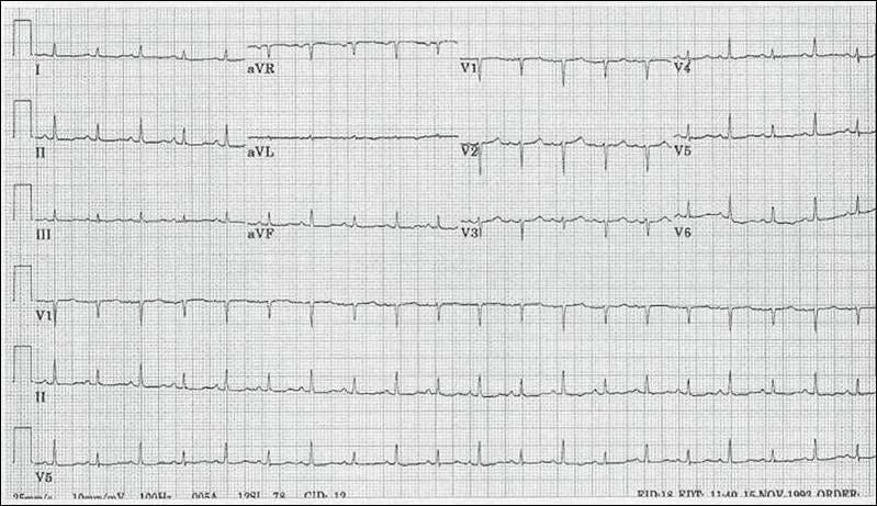 Hình 12 Cách hồi điện học ở một bệnh nhân tràn dịch màng ngoài tim lượng dịch nhiều Hình 13 - Hình ảnh cách hồi điện học ở một bệnh nhân tràn dịch màng ngoài tim nhiều có ép tim Cách hồi điện học
