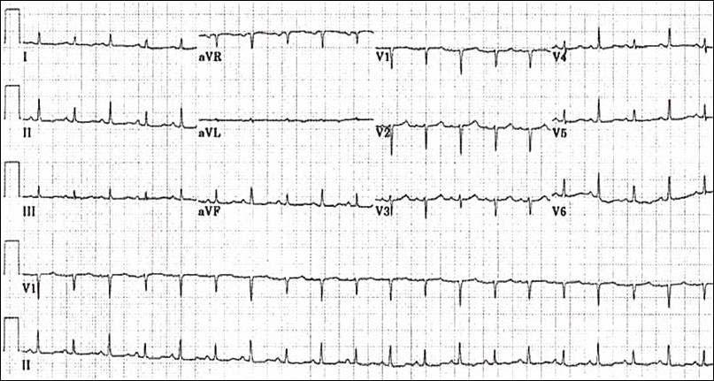 Cách hồi điện học với nhịp nhanh xoang là dấu hiệu có độ đặc hiệu cao trong ép tim nhưng độ nhạy ở mức độ vừa phải, do đó không có dấu hiệu này cũng không loại trừ ép tim [2]. TÀI LIỆU THAM KHẢO 1.