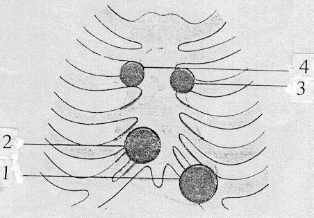 Hình 16: Các vị trí nghe tiếng tim trên lồng ngực. 1. Ổ van 2 lá. 3. Ổ van động mạch phổi. 2. Ổ van 3 lá. 4. Ổ van động mạch chủ. - Liên sườn V đường giữa đòn trái (ổ van 2 lá).