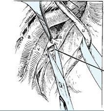 Mở áo động mạch Tách các mô lỏng lẻo bằng kéo bóc tách cùn theo chiều các mạch máu.
