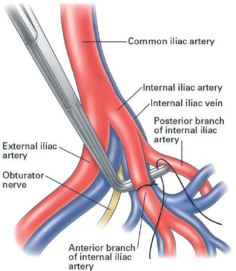 Thắt động mạch hạ vị Cần bóc tách tĩnh mạch và ĐM riêng ra trong trường hợp nó dính nhau.