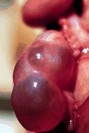 - U nang thể vàng (luteal cyst): thường chỉ có một cấu trúc nang trên một buồng trứng, thành nang dày hơn.
